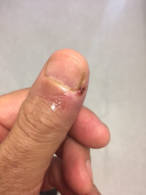 Thumb_After